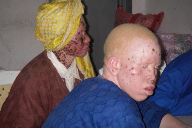 Malawi leader condemns attacks on people with albinism: UN