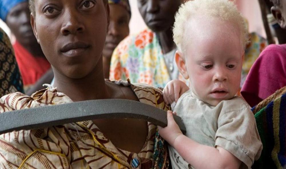Albinism: UN official welcomes latest developments in ‘landmark’ Malawi murder case