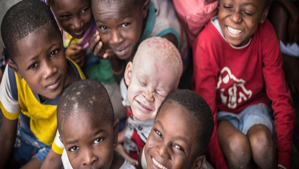 Recognize, celebrate and ‘stand in solidarity’ with persons with albinism