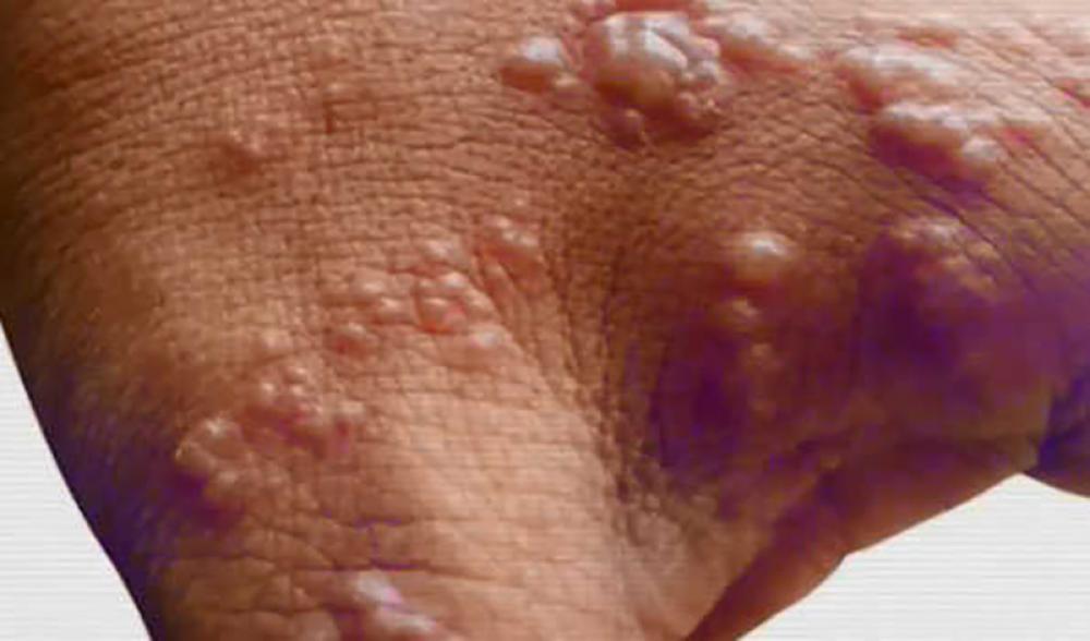 Cambodian man diagnosed with monkeypox: Reports
