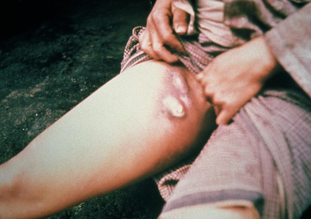 Bubonic plague case detected in US