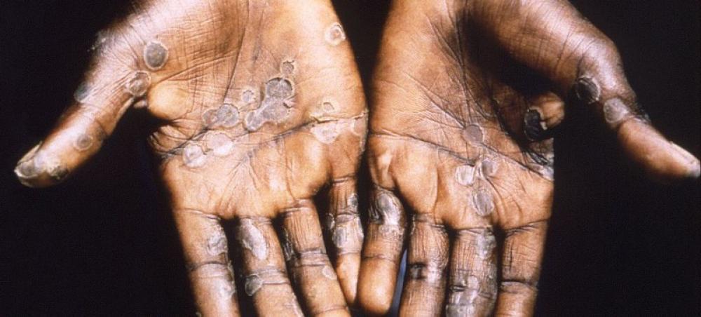 Canada registers first case of clase I mpox