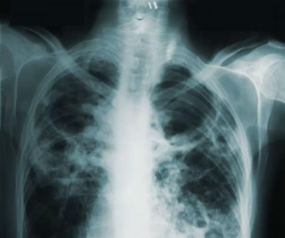 Could this be the beginning of the end for Tuberculosis? All details inside 