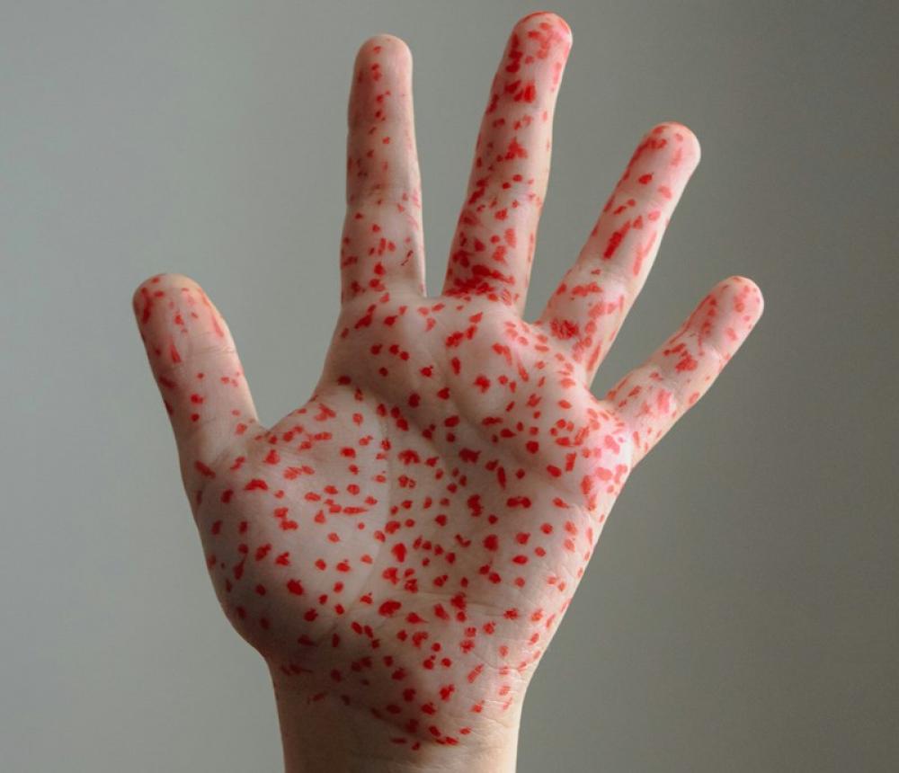 Can measles cross borders? Bangladesh crisis sparks fear in India 