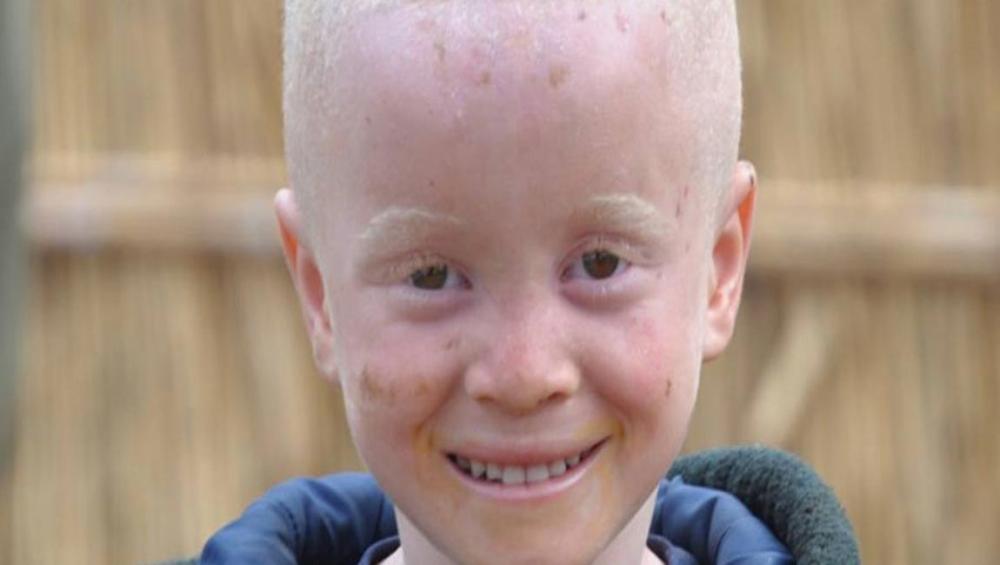 Kenya makes progress in supporting people with albinism, but ‘much remains to be done’ says UN expert