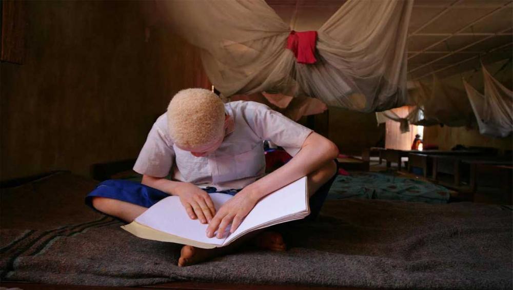 Joint African action crucial to protect persons with albinism from violence, highlights UN expert