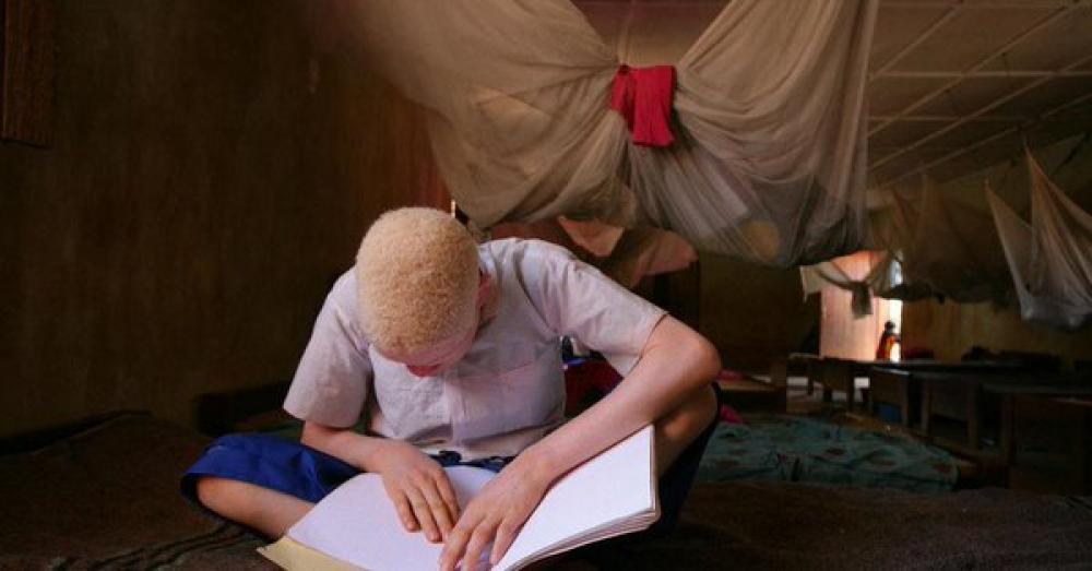 ‘Much more’ can be done to raise awareness about the plight of persons with albinism: UN chief