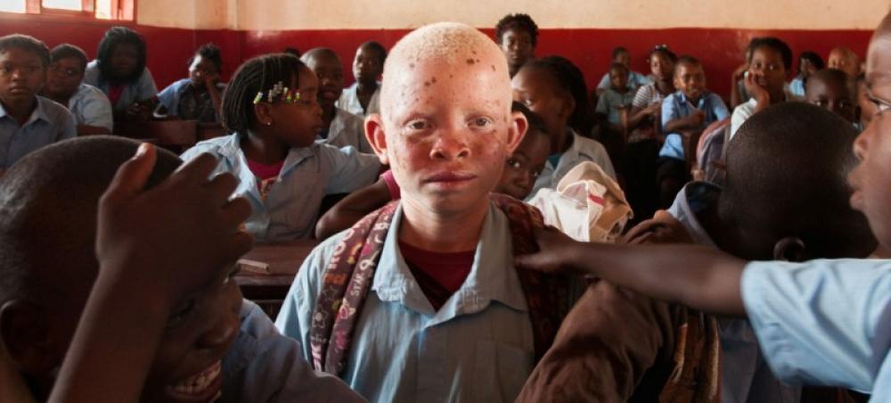 'Demystify' albinism and end discrimination: UN chief